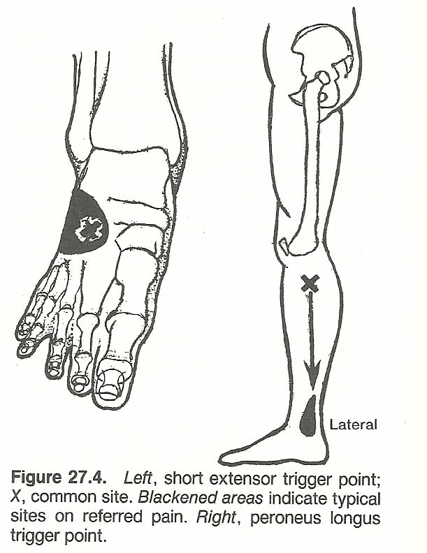 PERONEI STRAIN AND INFLAMMATION