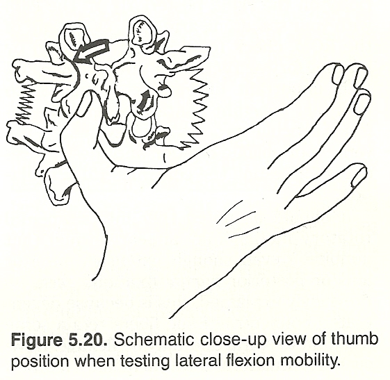 Spondylolisthesis image