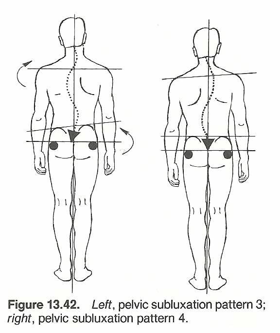 Biomechanical Considerations in the Therapy of Thoracic Scoliosis