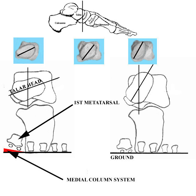 Retention of Calcaneal Supinatus The Clubfoot deformity.